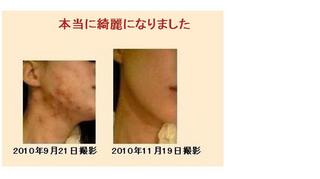 敏感肌のための、本当に正しいニキビケア.jpg